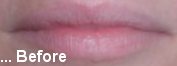 Lips Before Treatment