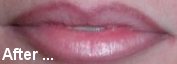 Lips After Treatment